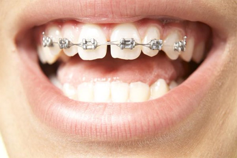 Mất bao lâu để có một hàm răng đẹp? (Ảnh: Internet)