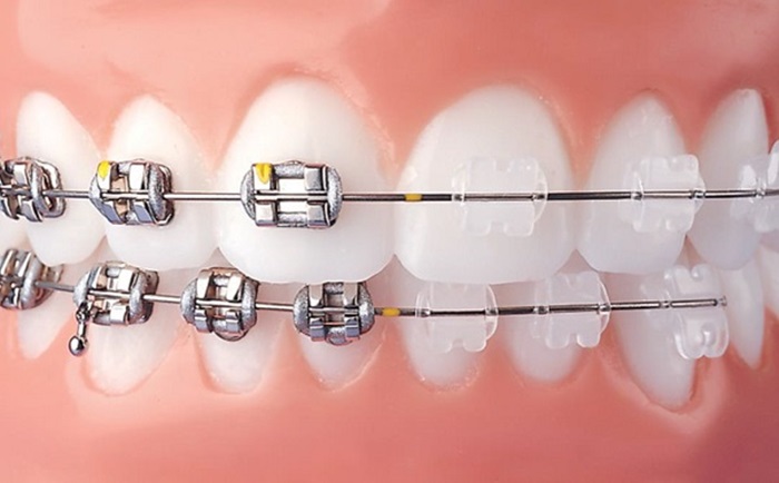 Niềng răng mắc cài sứ có tính thẩm mỹ tốt hơn so với niềng răng mắc cài kim loại