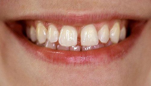 Các cách niềng răng thưa phổ biến hiện nay