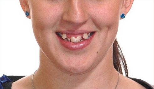 <strong>Răng khểnh là gì? Nguyên nhân và những tác hại của răng khểnh mang đến cho bạn</strong>