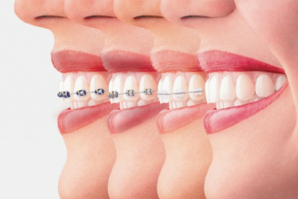 Yếu tố nào ảnh hưởng đến thời gian niềng răng và chỉnh răng?