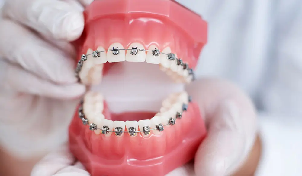 Những yếu tố ảnh hưởng đến thời gian niềng răng