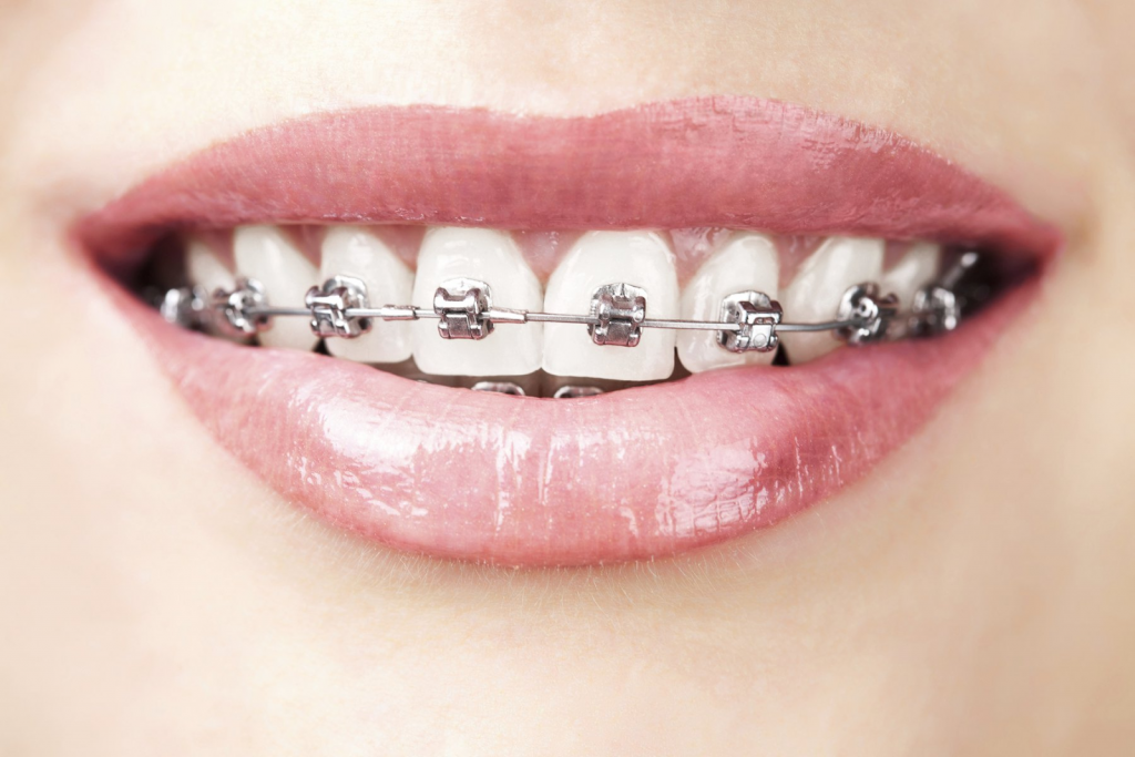 Cách phân biệt niềng răng trong suốt và niềng răng mắc cài