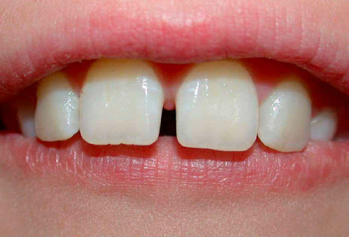 Thời gian niềng răng trong 3-6 tháng có được không?