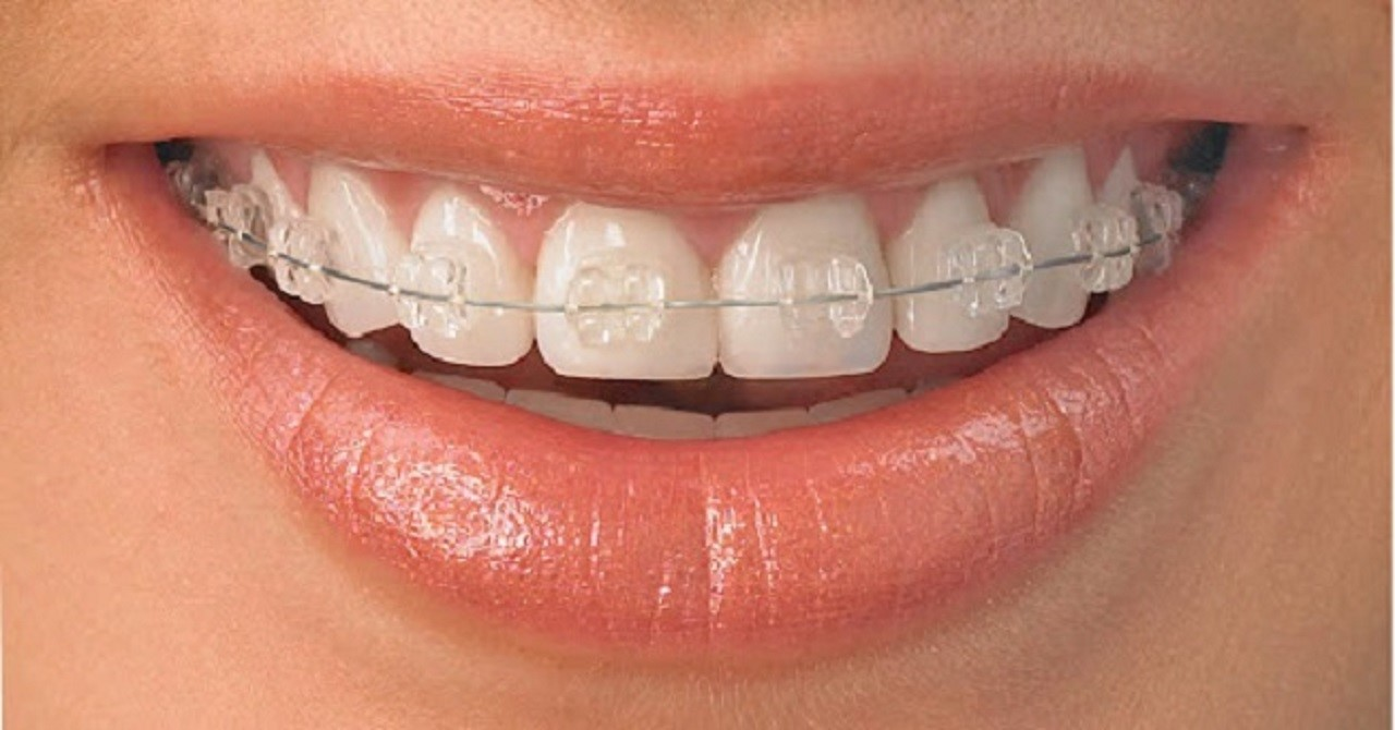 Kết quả niềng răng thay đổi cuộc sống bạn như thế nào?