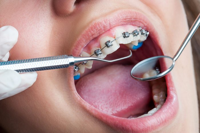 Niềng răng thưa là một trong những phương pháp cải thiện răng miệng hiệu quả