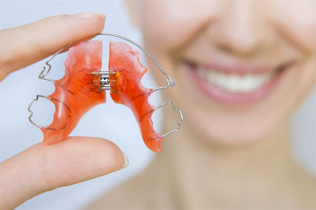 Có cần thiết đeo hàm duy trì sau niềng răng không? Lợi ích của chúng là gì?