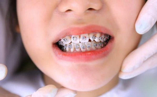 Nẹp răng là gì? Độ tuổi nào nên chọn phương pháp này?