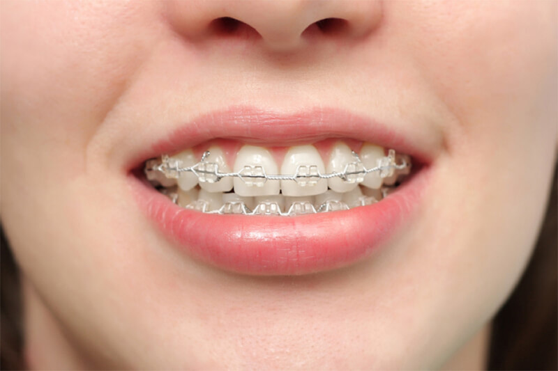 <strong>Những yếu tố ảnh hưởng đến thời gian niềng răng</strong>