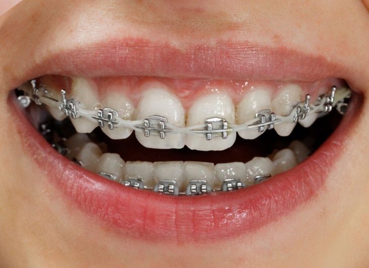 Niềng răng mắc cài là gì? Có bao nhiêu loại?