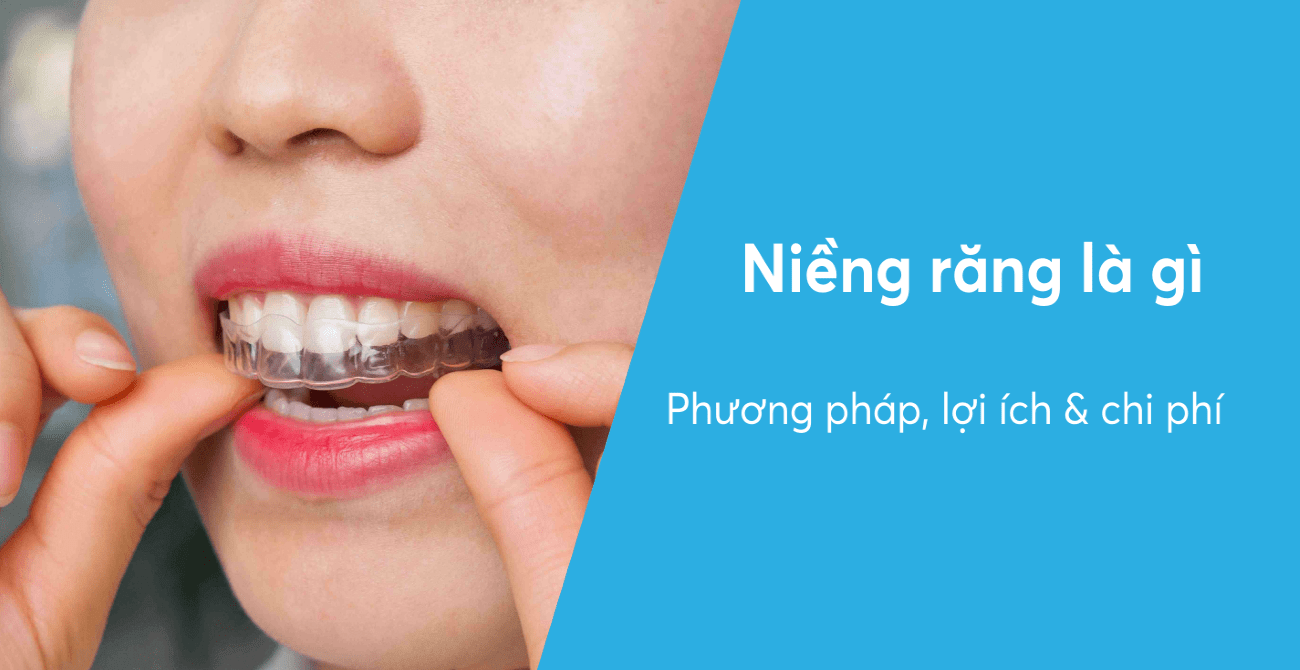 Niềng Răng là gì? Nguyên nhân và phương pháp điều trị, giá bao nhiêu