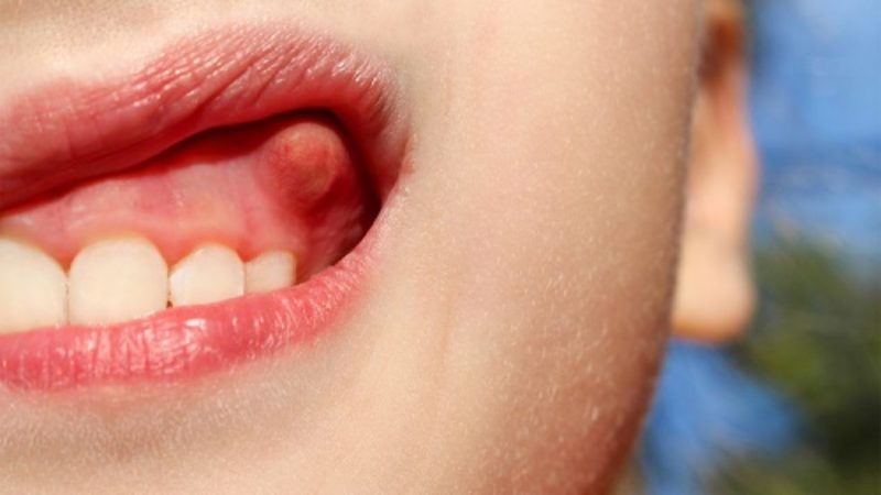 Áp xe răng xuất hiện ở vùng nướu chân răng.