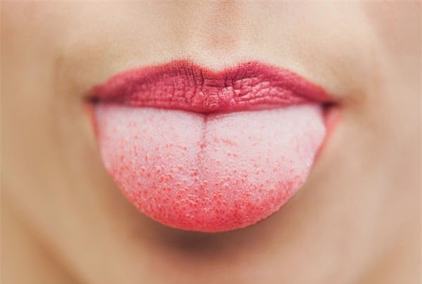 Nhú lưỡi bị sưng khiến vi khuẩn đọng lại gây trắng lưỡi.