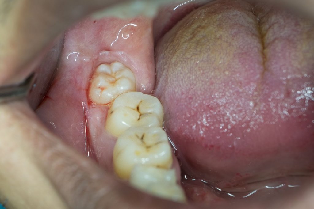 Răng khôn gần như không có tác dụng về chức năng nhai hay về thẩm mỹ mà còn có thể gây biến chứng nguy hiểm về răng miệng.