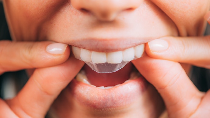 Miếng dán trắng răng có thực sự hiệu quả?