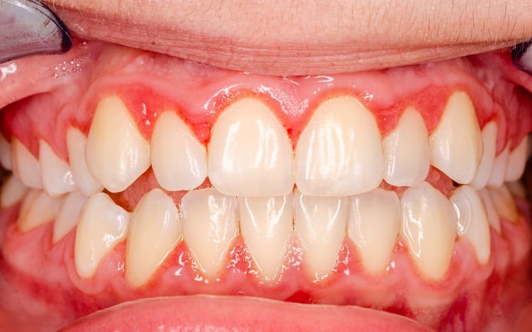 Những câu hỏi thường gặp khi chăm sóc răng miệng