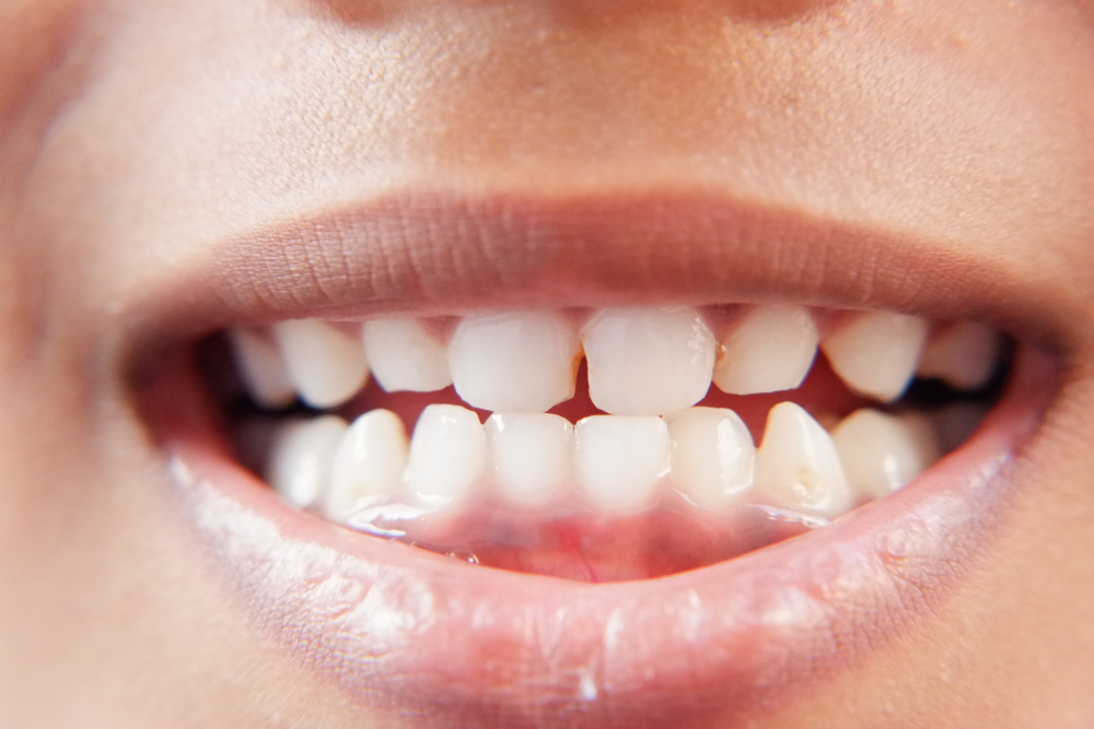 Các lợi ích của việc bảo vệ răng cho bé từ sớm