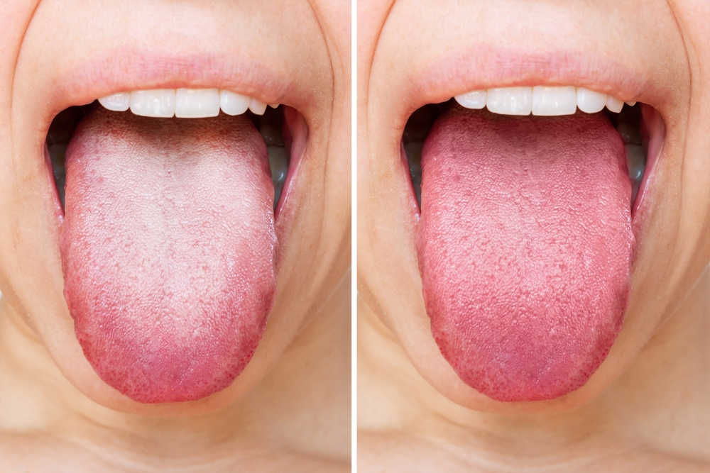 Nguyên nhân khiến lưỡi bị trắng kèm hôi miệng và cách điều trị