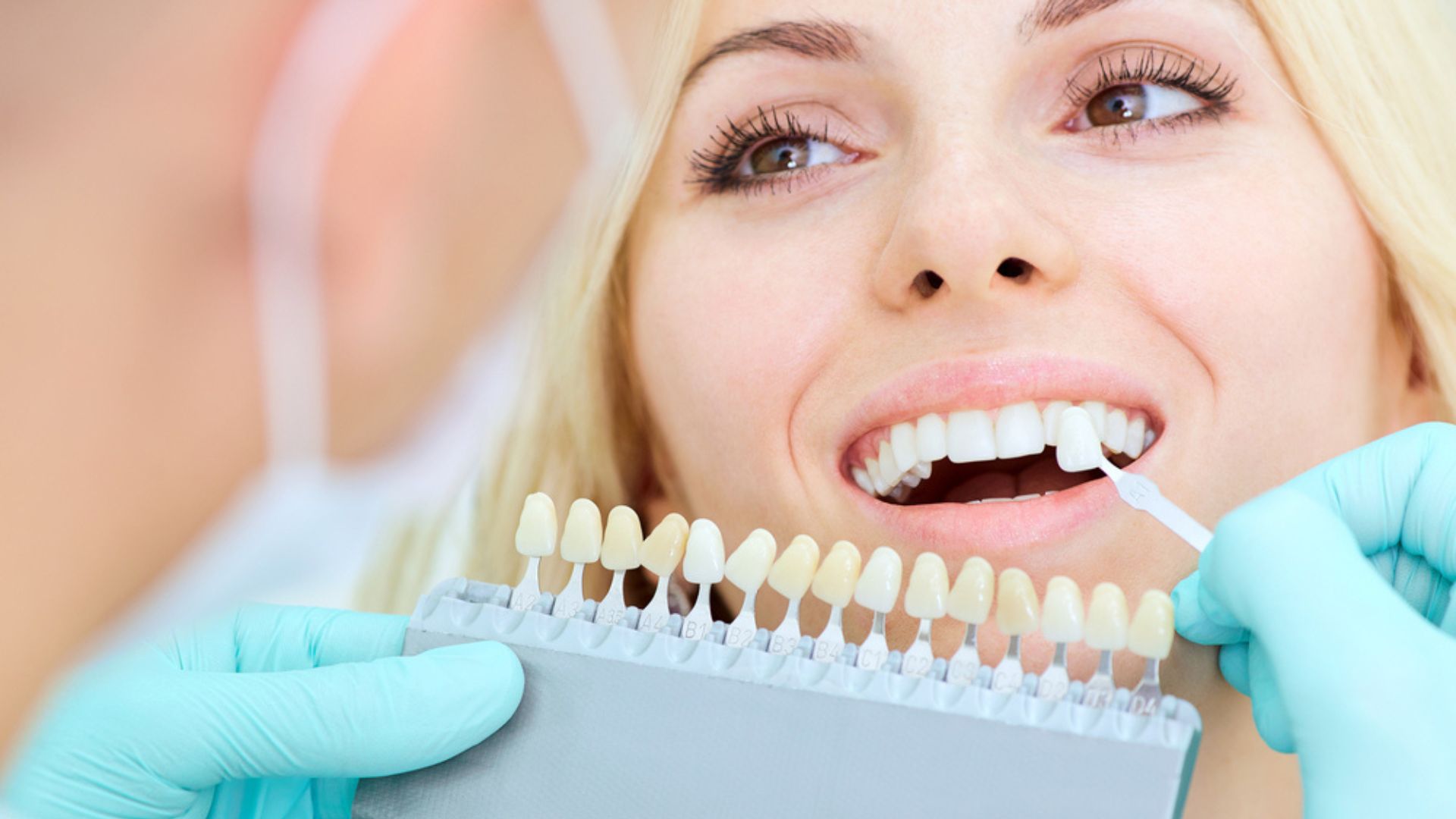 Răng vàng bẩm sinh: Nguyên nhân và cách khắc phục