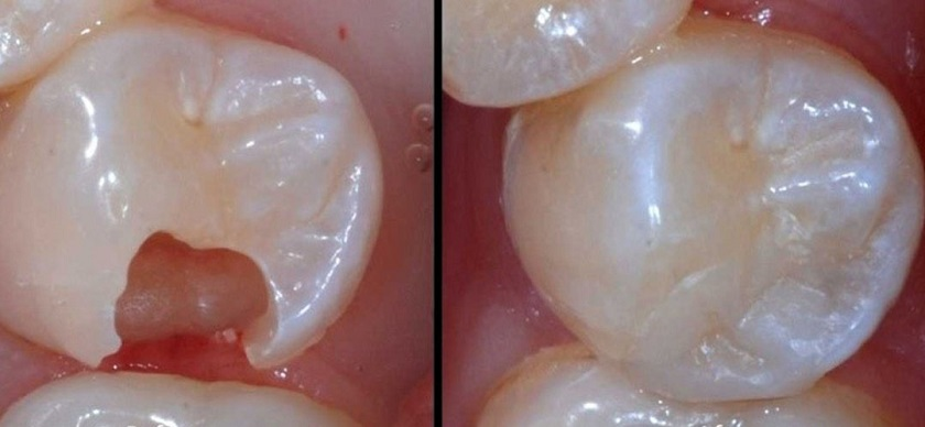 Mẻ răng hàm là gì? Nguyên nhân và cách khắc phục