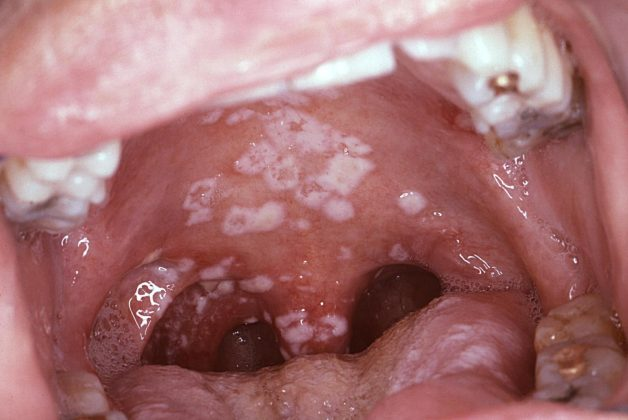 Nhiễm nấm Candida là gì? Cách điều trị nấm miệng ở người lớn