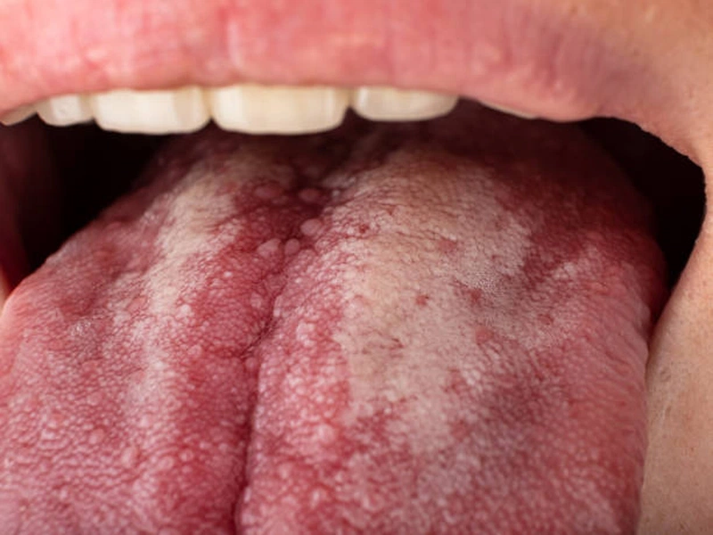 Bệnh Nấm Lưỡi và Phương Pháp Điều Trị
