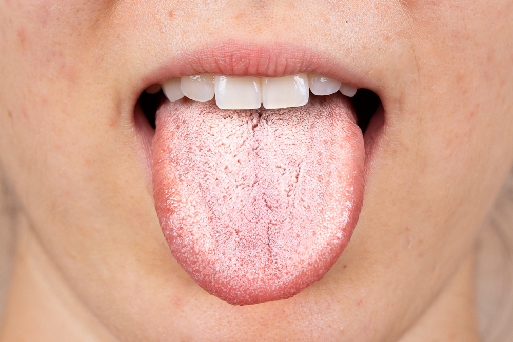 Lưỡi trắng là gì? Cách khắc phục tình trạng lưỡi trắng
