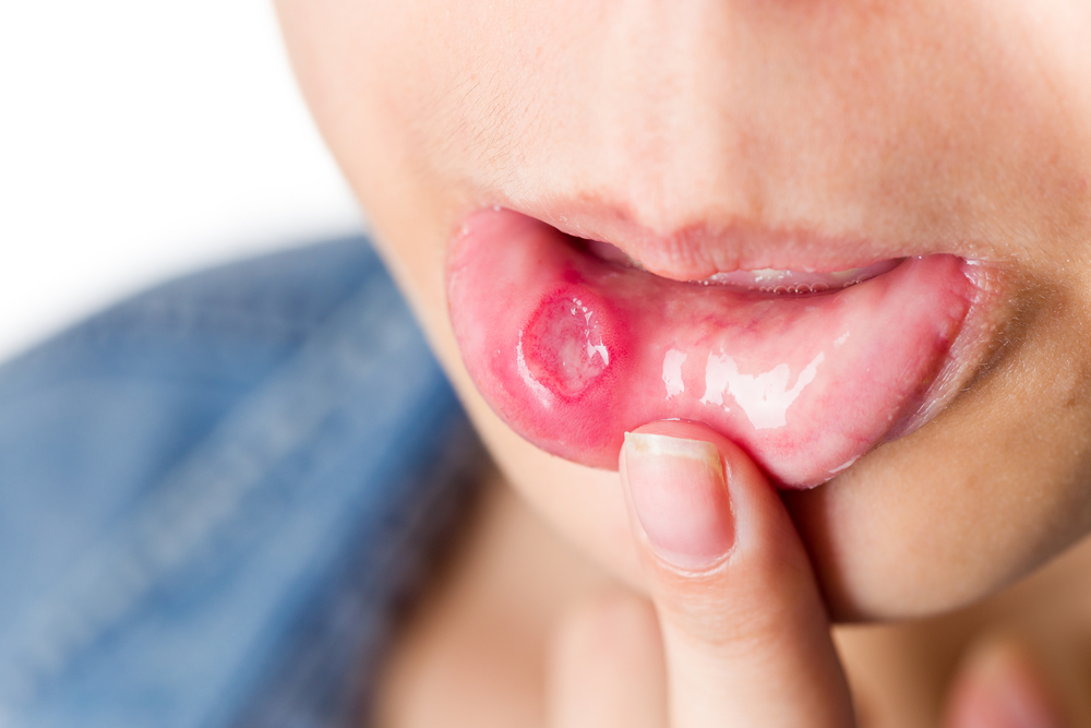 Không vệ sinh lưỡi thường xuyên sẽ gây lở loét miệng
