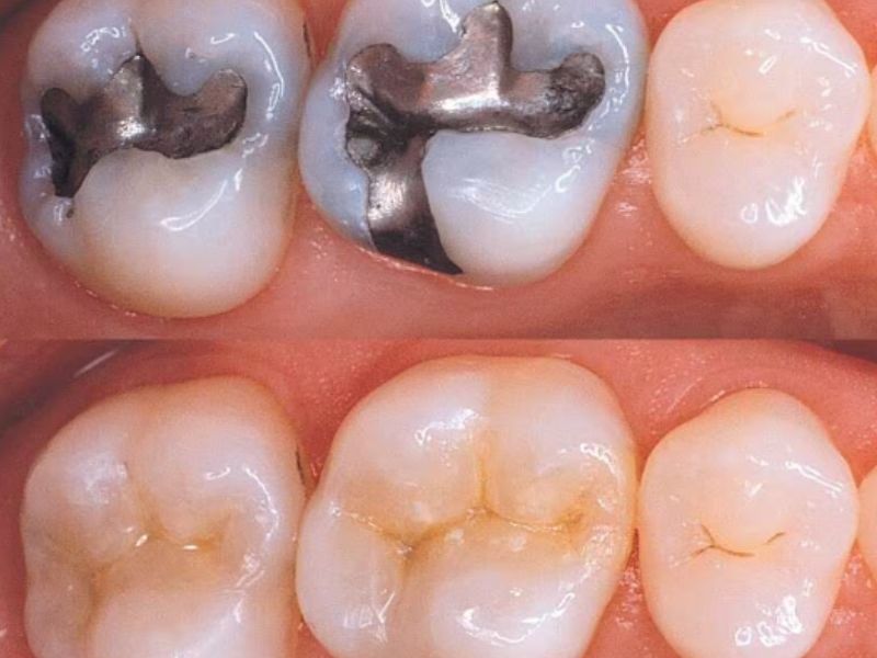 Hàn răng sâu có đau không? Quy trình hàn răng