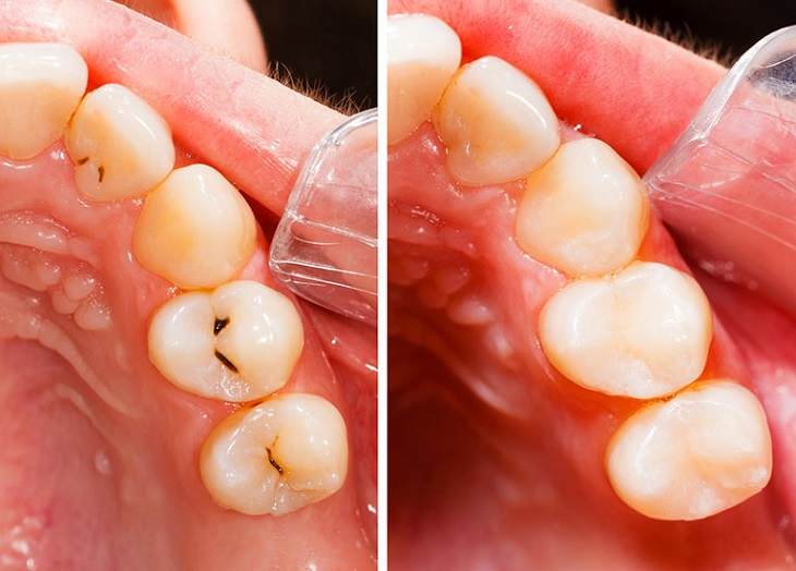 Dấu hiệu nhận biết sâu răng và cách phòng ngừa hiệu quả