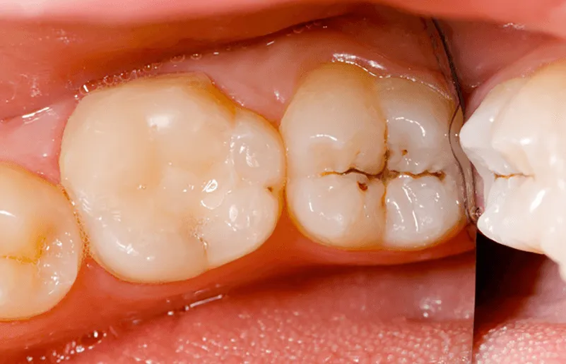 Các mức độ sâu răng và cách phòng ngừa răng sâu hiệu quả