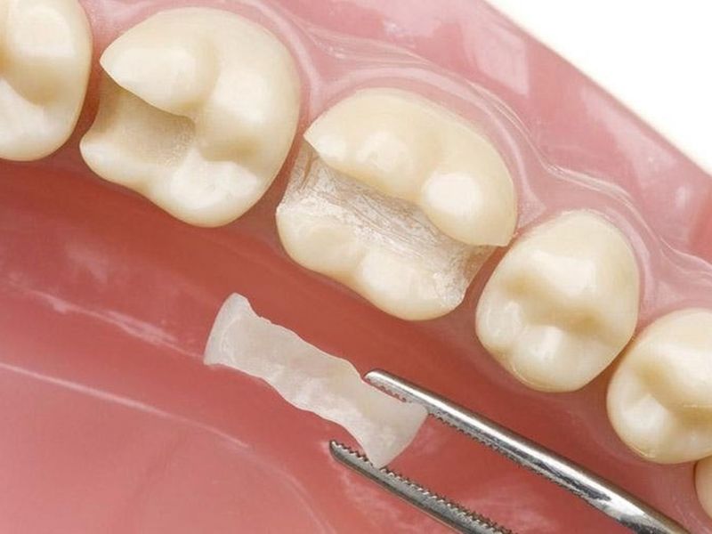 Trám răng là gì? Khi nào nên trám răng