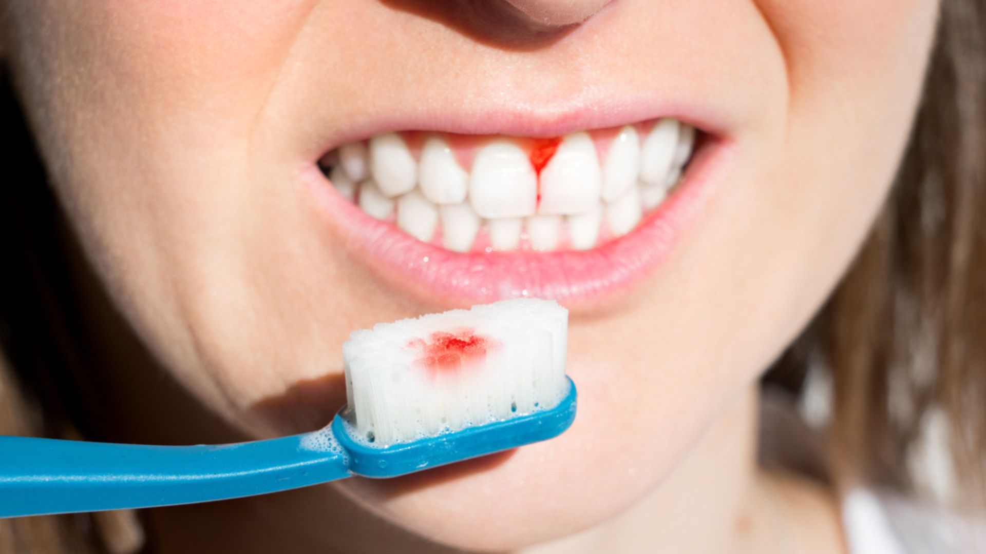 Thường xuyên chảy máu khi đánh răng có sao không?