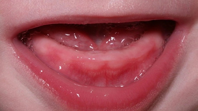 Dấu hiệu mọc răng sữa ở trẻ và cách chăm sóc khi trẻ mọc răng