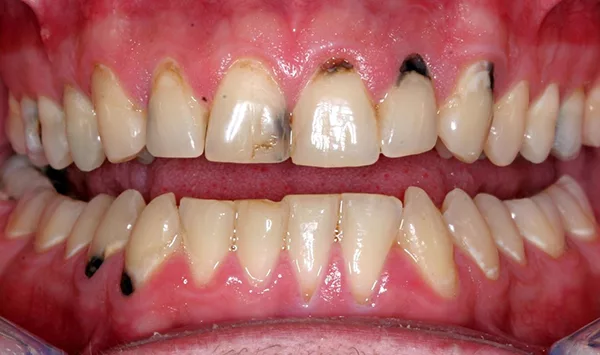 Nguyên nhân và dấu hiệu nhận biết sâu răng cửa