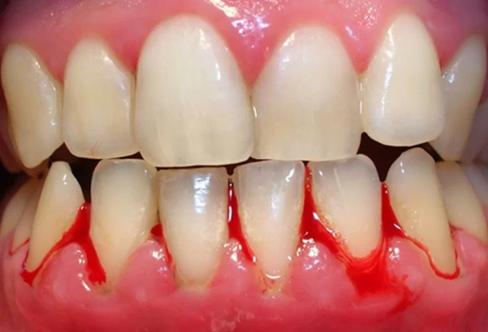 Răng bị chảy máu là bệnh gì? Nguyên nhân gây chảy máu