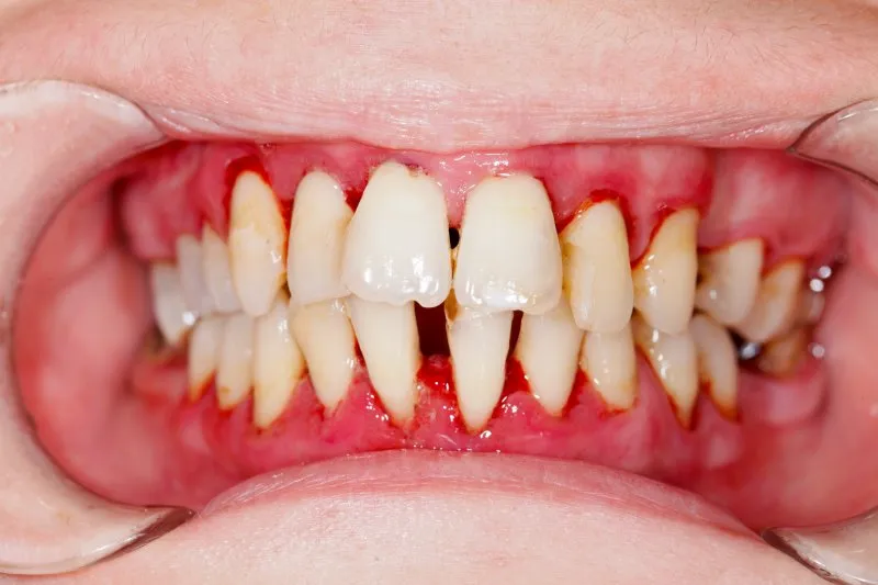 Răng bị nha chu là gì? Nguyên nhân và dấu hiệu nhận biết