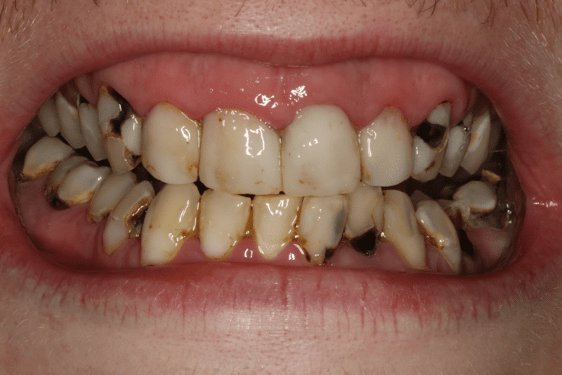Sâu răng là gì? Nguyên nhân gây sâu răng phổ biến