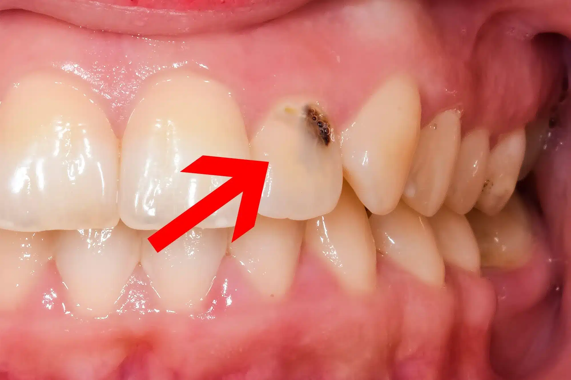 Sâu răng là gì? Cách điều trị răng sâu hiệu quả
