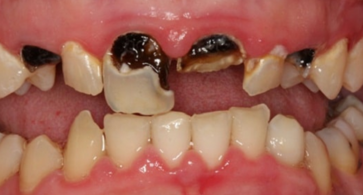 Sâu chân răng cửa là gì? Cách khắc phục hiệu quả