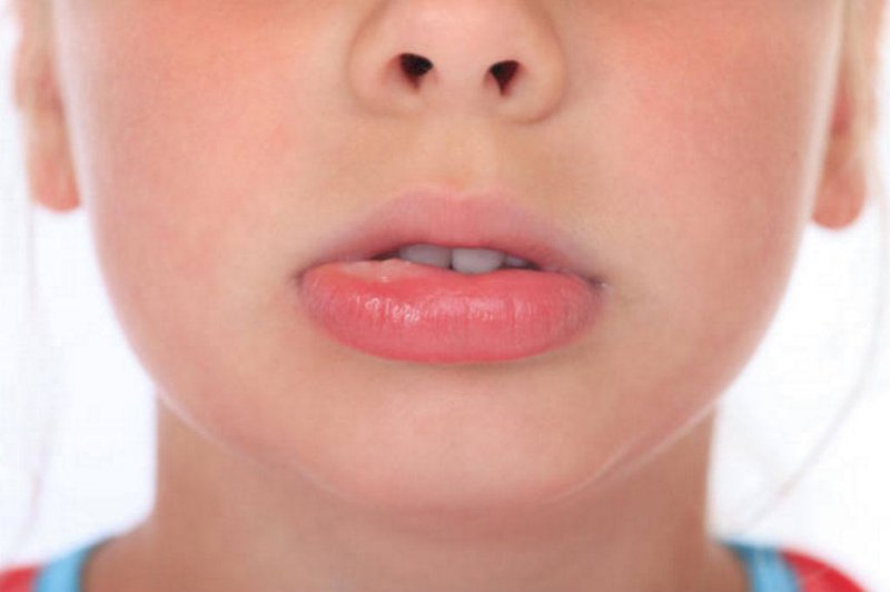Sưng môi là gì? Triệu chứng và cách điều trị hiệu quả