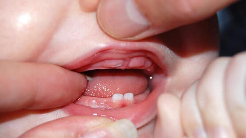 Trẻ mấy tháng mọc răng? Lịch và thứ tự trẻ mọc răng sữa