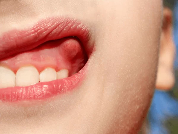 Áp xe răng là gì? Cách chữa trị áp xe răng hiệu quả