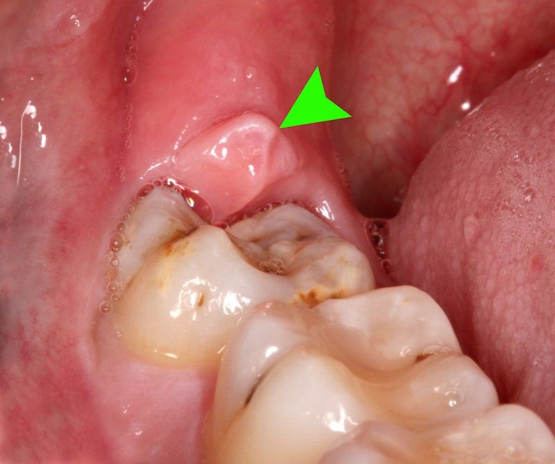 Áp xe răng là gì? Triệu chứng và cách phòng ngừa hiệu quả