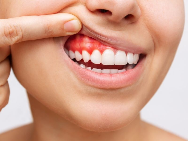 Nướu răng bị sưng: Nguyên nhân và cách chữa trị hiệu quả