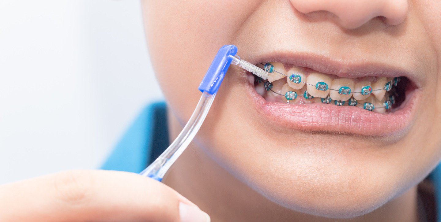 Bàn chải kẽ răng là gì? Công dụng và lưu ý khi dùng