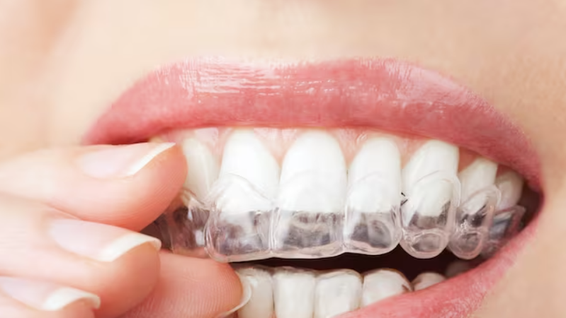 Tác dụng phụ gel làm trắng răng mà bạn nên biết