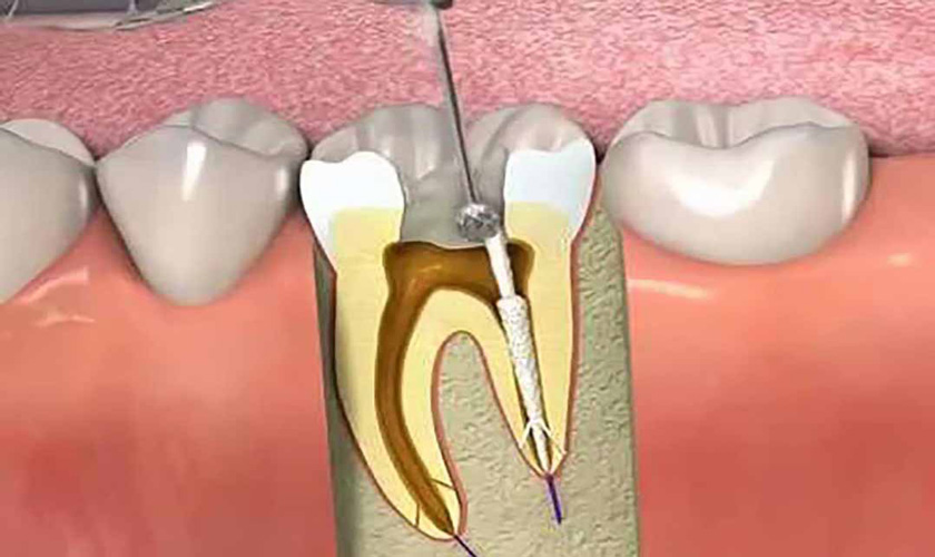 Lấy tủy răng là gì? Quá trình này có đau không?