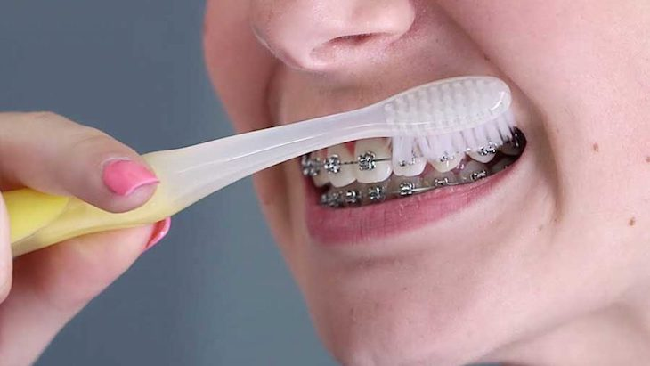 Cách chọn bàn chải đánh răng cho người niềng răng