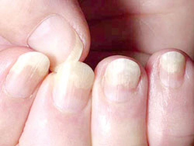 Móng tay bị lõm nguyên nhân và dấu hiệu xuất hiện bệnh